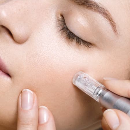 Microneedling Face + Neck at B3 Beauty Salon LLC in Joplin, MO